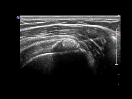 Ultrasound Guided Barbotage Procedure For Calcific