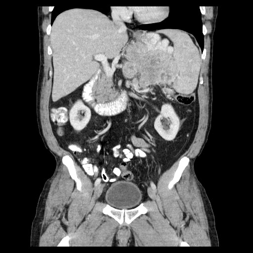 Massive Pancreas Neuroendocrine Tumor | Image | Radiopaedia.org