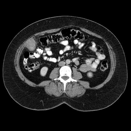 Mesenteric smooth muscle neoplasm | Radiology Case | Radiopaedia.org