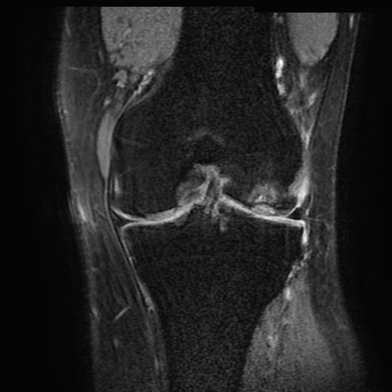 Osteochondritis dissecans of the knee | Radiology Reference Article ...