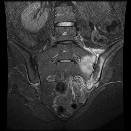 Septic sacroiliitis - brucellosis | Radiology Case | Radiopaedia.org