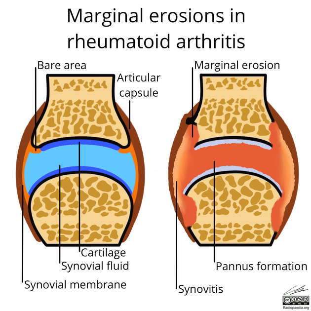 Rheumatoid Arthritis Diagram