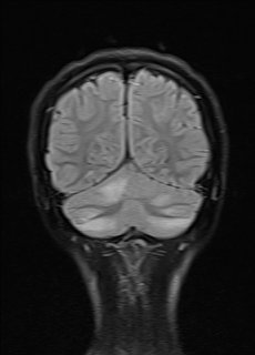 Acute cerebellitis | Image | Radiopaedia.org