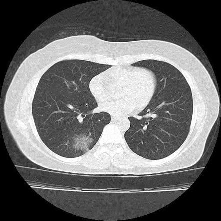 COVID-19 | Radiology Reference Article | Radiopaedia.org