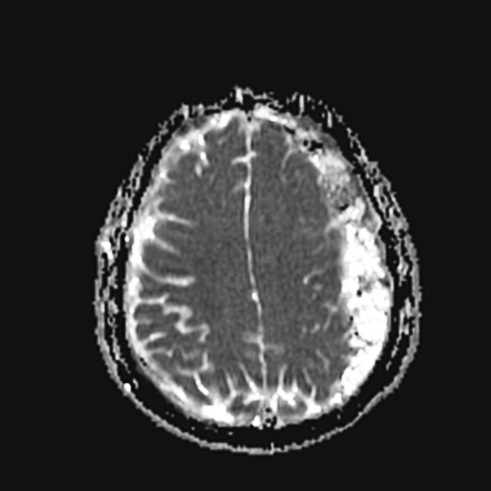 Spontaneous Bilateral Subdural Hemorrhage 