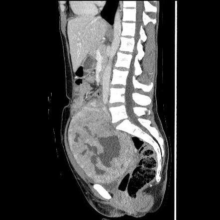 Cystic degeneration of a large fibroid | Radiology Case | Radiopaedia.org