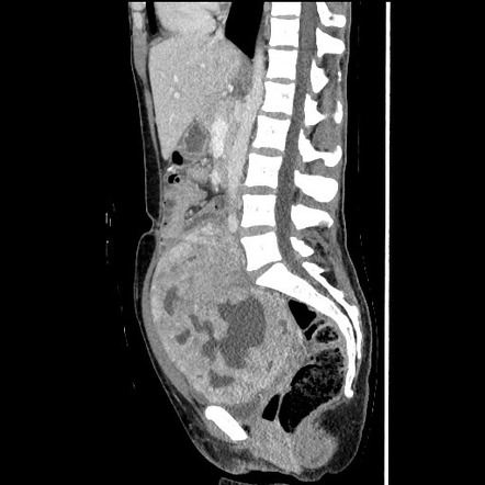 Cystic degeneration of a leiomyoma | Radiology Reference Article ...