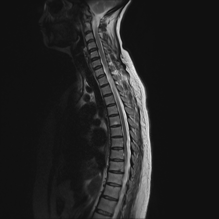 Scalpel sign (spinal cord) | Radiology Reference Article | Radiopaedia.org