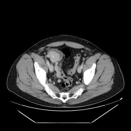 Splenosis - mimicking peritoneal masses | Radiology Case | Radiopaedia.org