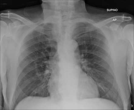 COVID-19 pneumonia | Image | Radiopaedia.org