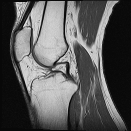 Congenital absence of anterior cruciate ligament | Image | Radiopaedia.org