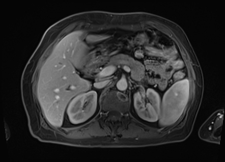 Intraductal papillary neoplasm of the bile duct | Image | Radiopaedia.org