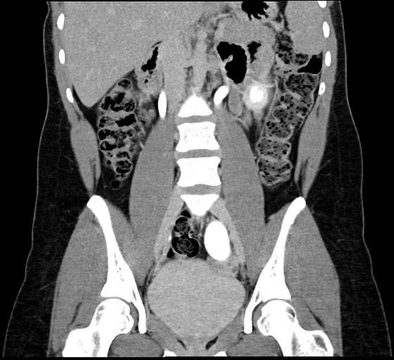 Rapidly Growing Abdominal Wall Desmoid Tumor During Pregnancy Image 3416