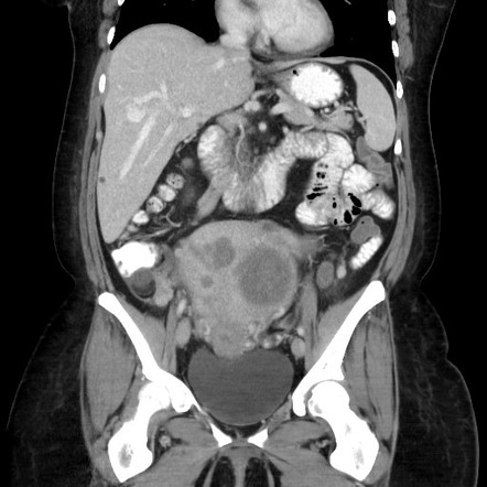 Large uterine fibroids | Image | Radiopaedia.org