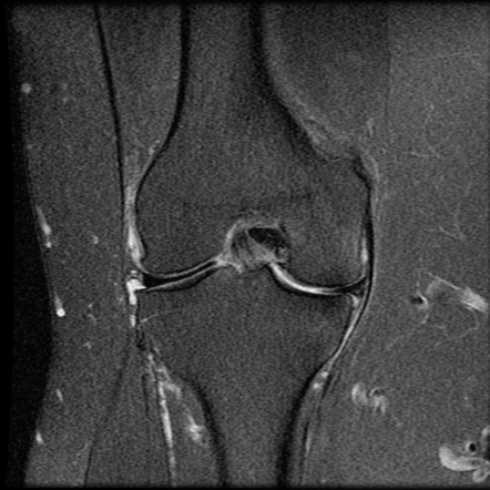 Meniscal extrusion | Radiology Reference Article | Radiopaedia.org