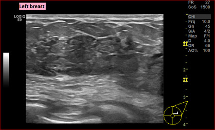 Acute Mastitis Ultrasound