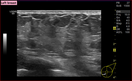 Puerperal interstitial mastitis | Image | Radiopaedia.org