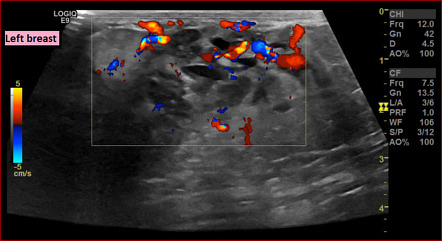 Puerperal mastitis | Radiology Reference Article | Radiopaedia.org