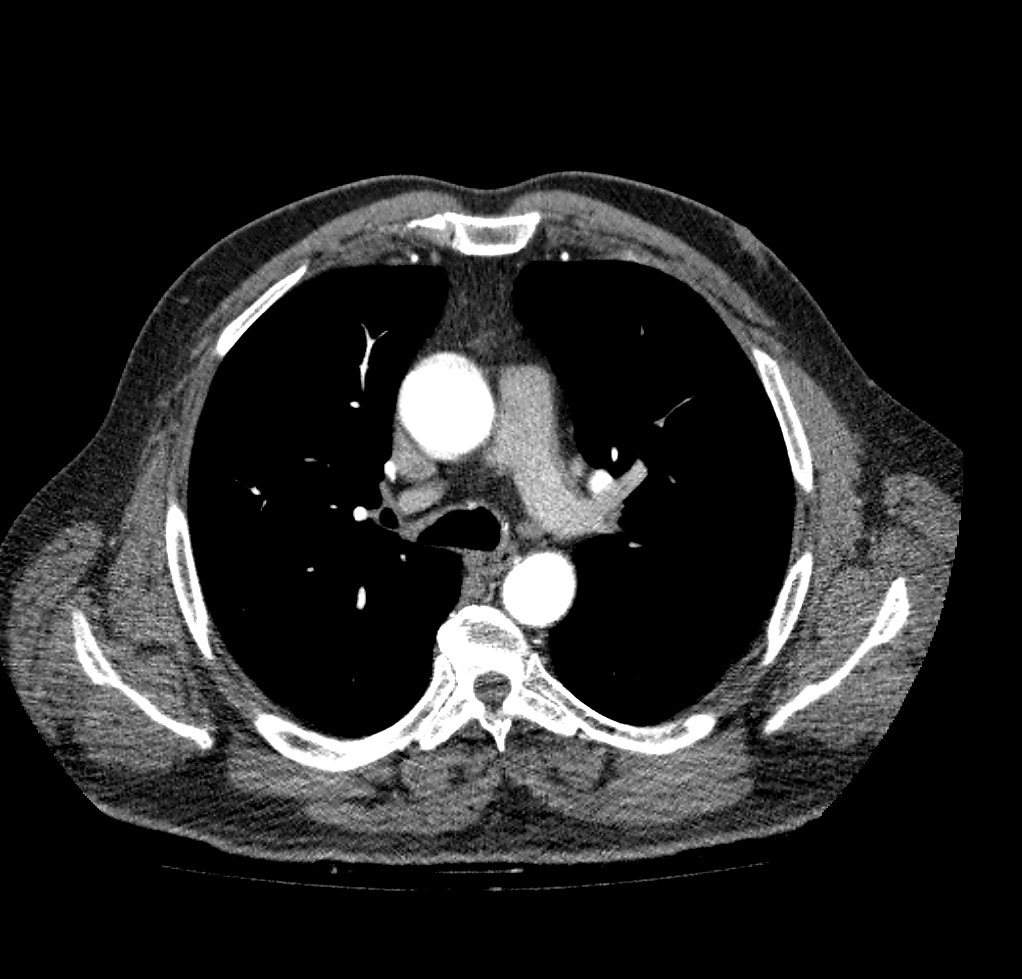 Azygos arch valve | Image | Radiopaedia.org