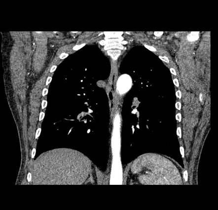 Azygos arch valve | Image | Radiopaedia.org