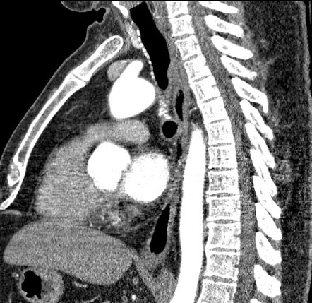 Azygos arch valve | Image | Radiopaedia.org