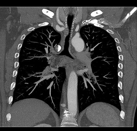 Azygos arch valve | Radiology Reference Article | Radiopaedia.org