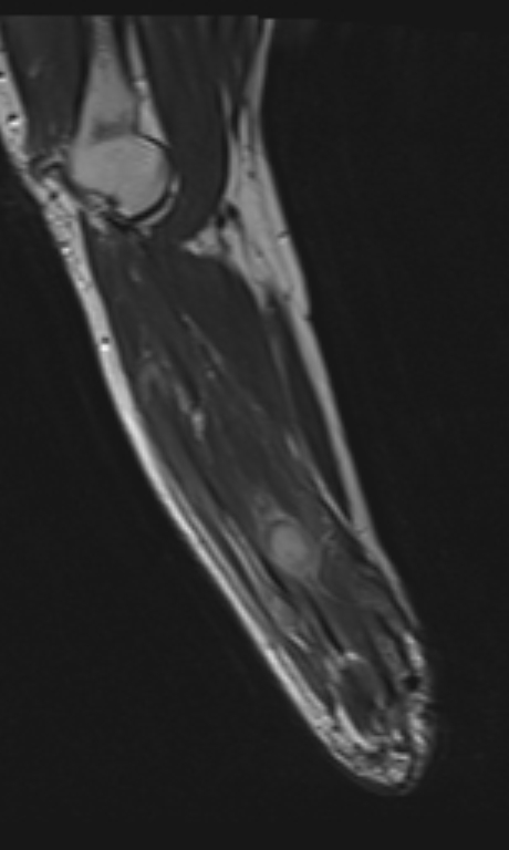 Stump neuroma - upper limb | Image | Radiopaedia.org