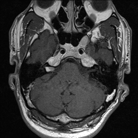 Internal auditory canal schwannoma and lipoma | Image | Radiopaedia.org