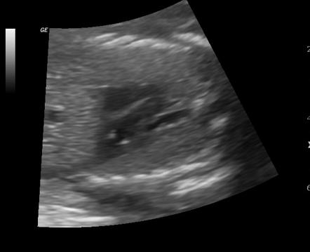 Echogenic cardiac focus | Image | Radiopaedia.org