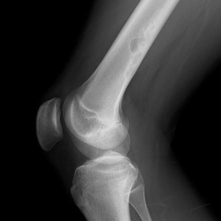 Non-ossifying fibroma - distal femur | Image | Radiopaedia.org