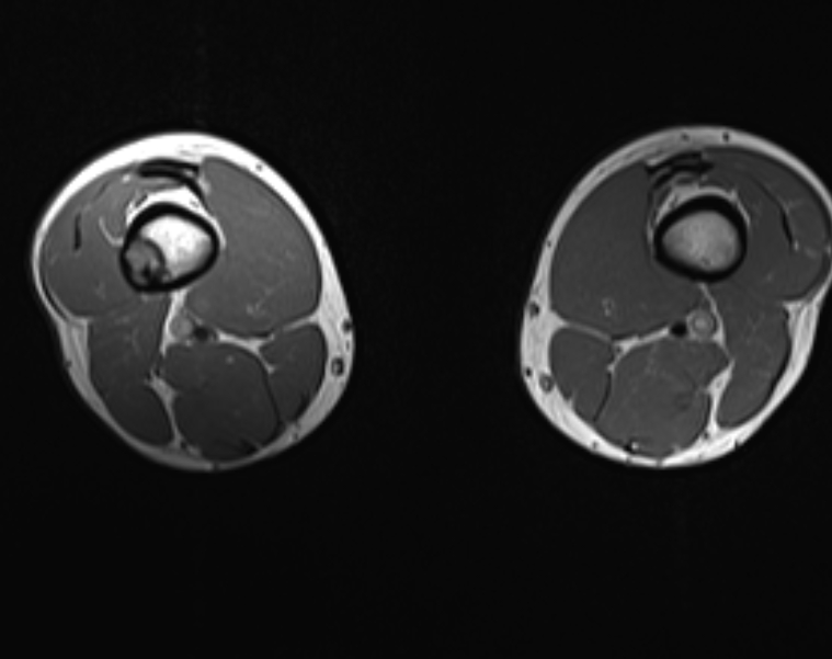 Ossifying Fibroma Femur