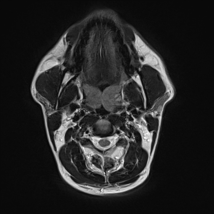 Tonsillitis X Ray