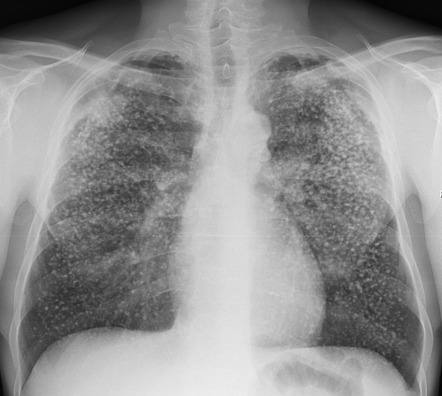 Calcified pulmonary nodules | Radiology Reference Article | Radiopaedia.org