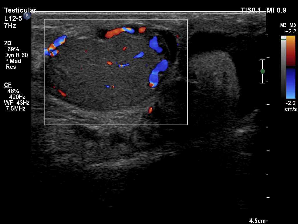 Intratesticular Varicocele Image