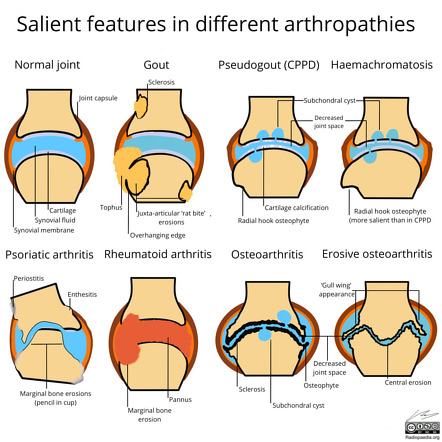 Arthritis | Radiology Reference Article | Radiopaedia.org