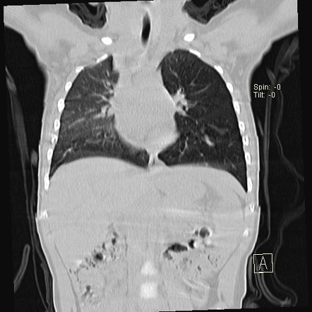 Endobronchial foreign body impaction with air trapping | Image ...