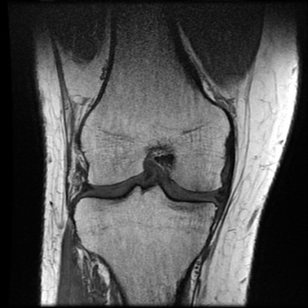 Anterior cruciate ligament tear with posteromedial corner injury ...