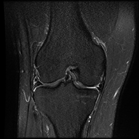 Bucket-handle meniscal tear | Radiology Reference Article | Radiopaedia.org