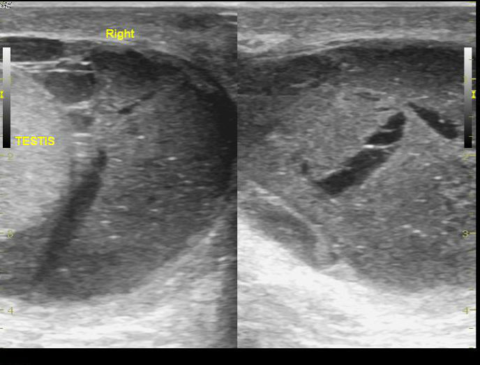 Scrotal Hematocele Image