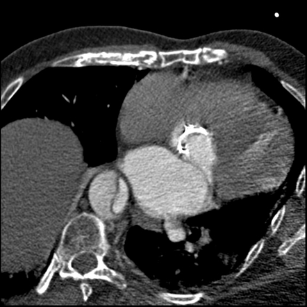 Aortic dissection (CTPA) | Image | Radiopaedia.org