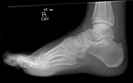 Fractured lateral and bipartite medial hallux sesamoid bones | Image ...