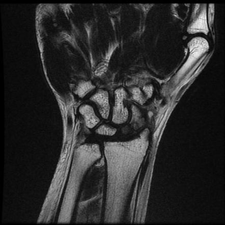 Scaphoid fracture and avascular necrosis | Image | Radiopaedia.org