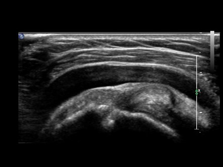 Subacromial Subdeltoid Bursa Injection Ultrasound Guided Radiology Case Radiopaedia Org