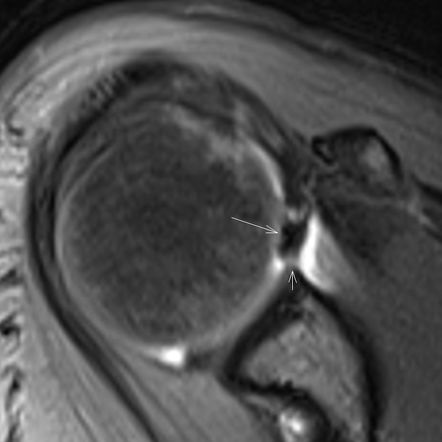 Superior Labral Anterior Posterior Tear | Radiology Reference Article ...