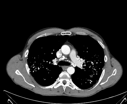 Silicosis with progressive massive fibrosis | Image | Radiopaedia.org