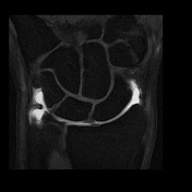 Arthrogram (MRI) | Radiology Reference Article | Radiopaedia.org