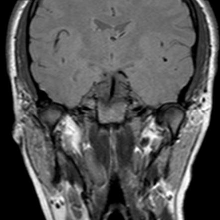 Temporomandibular Joint Disc Dislocation | Image | Radiopaedia.org