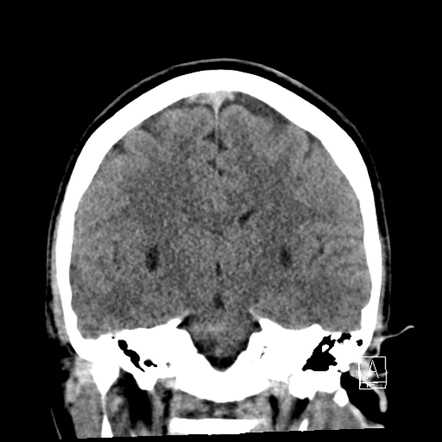 Basal ganglia chronic hypoxic ischemic disease | Image | Radiopaedia.org