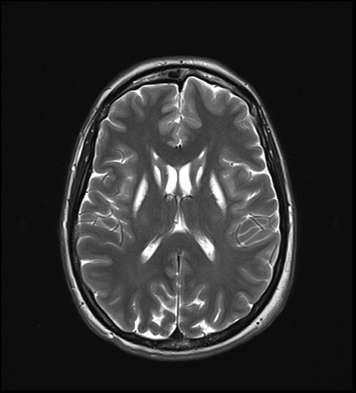 Basal ganglia T2 hyperintensity | Radiology Reference Article ...