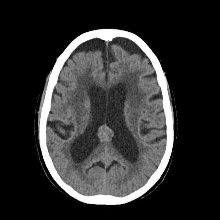 Septum pellucidum hemorrhage | Image | Radiopaedia.org